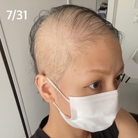 【画像】28歳女性、ワクチン接種後尋常じゃ無いスピードでハゲてしまう!「こんなことがあるのか…」 【画像】28歳女性、ワクチン接種後尋常じゃ無いスピードでハゲてしまう!「こんなことがあるのか…」