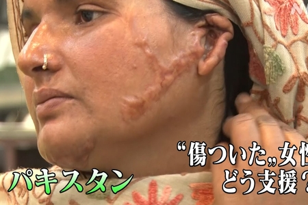 パキスタン 女性の顔や体に硫酸を浴びる「アシッドアタック」の背景には女性蔑視 日本人から怒りの声!まとめのカテゴリ一覧まとめまとめについて関連サイト一覧